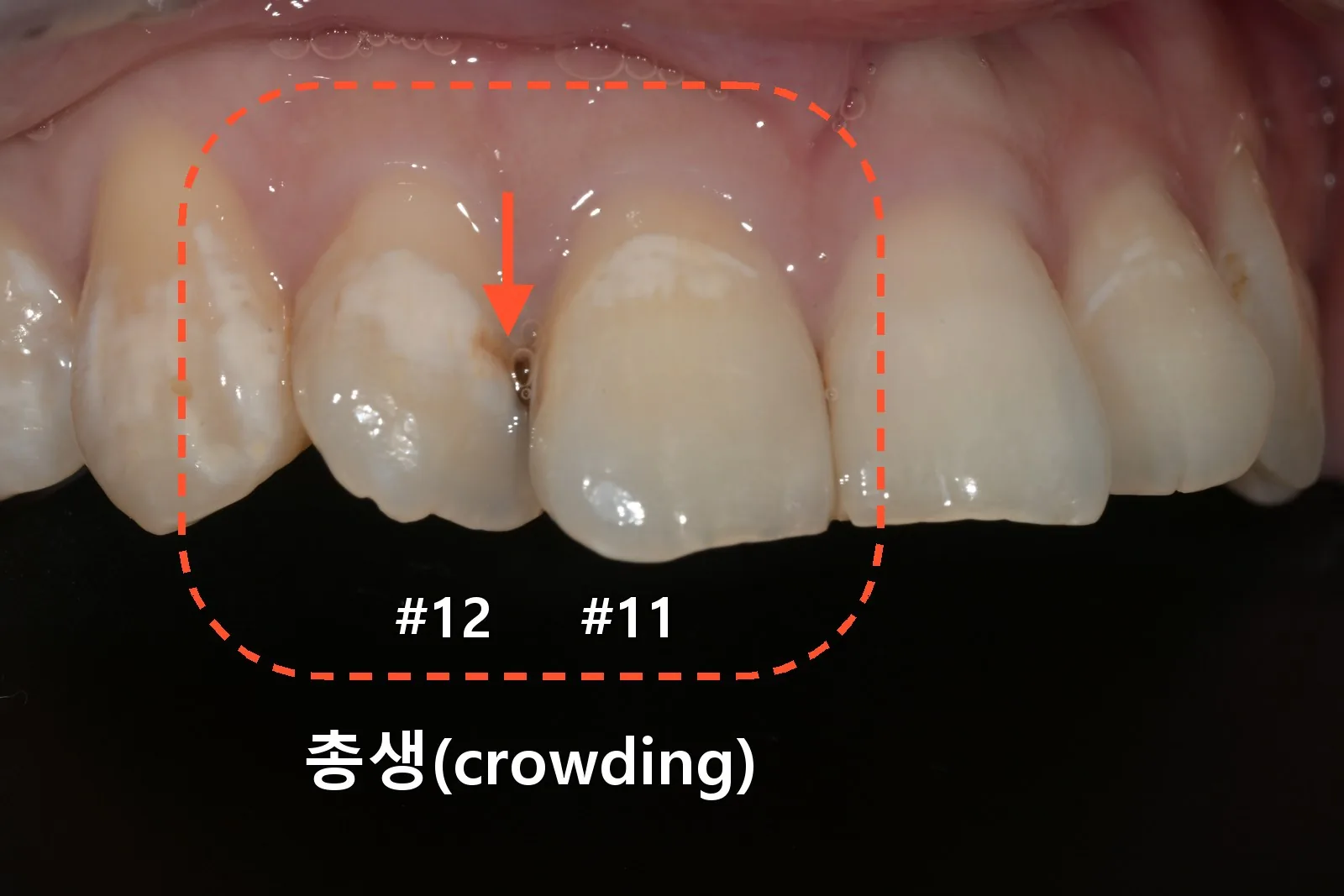 ภาพระยะใกล้ฟันซ้อนเก (crowding) ของฟัน #11 และ #12