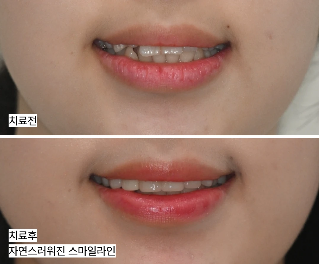 เปรียบเทียบแนวยิ้มก่อนและหลังรักษา แนวริมฝีปากที่ดูเป็นธรรมชาติขึ้น