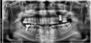 हड्डीजोड (osseointegration) पुष्टि गरेपछि पुनः राखेको इम्प्लान्ट