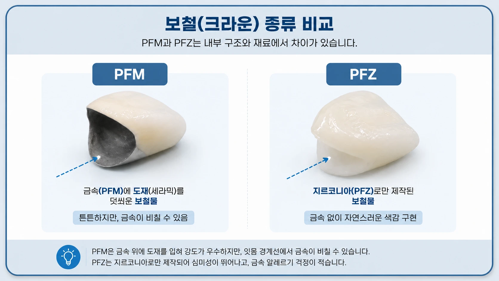 失活前牙所用修复体种类对比 — 氧化锆与其他材料的区别