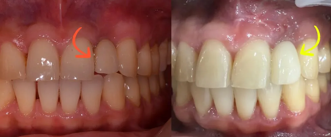 Comparison of intraoral photos before and 8 months after bone grafting — change in labial gum thickness