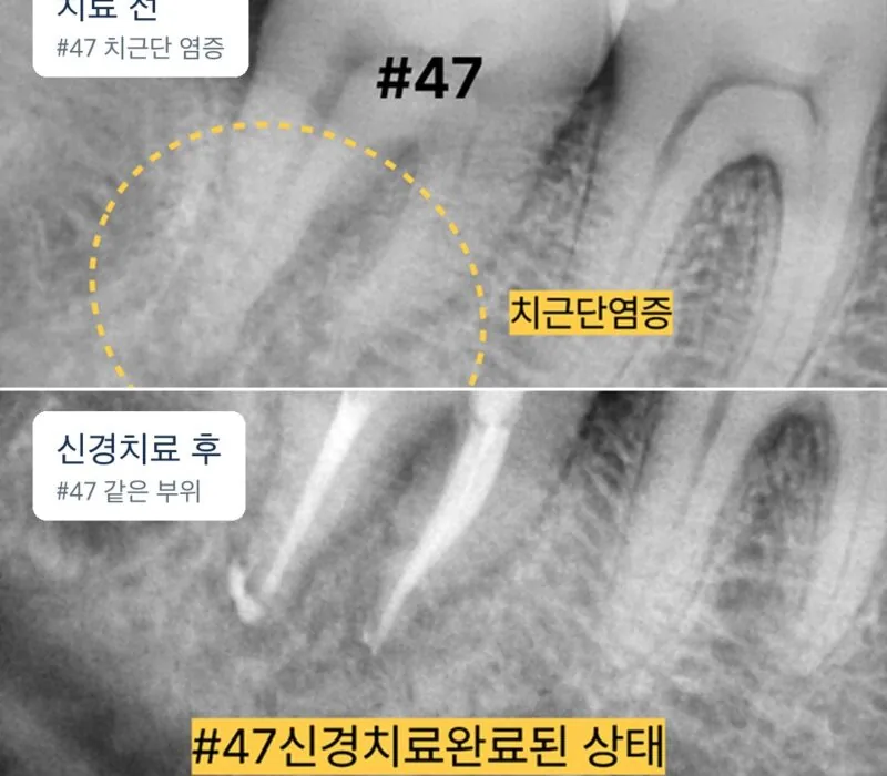 เปรียบเทียบการอักเสบปลายรากฟัน #47 (ก่อนรักษา) กับบริเวณเดียวกันหลังรักษารากฟันเสร็จสิ้น