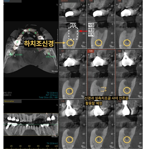 CBCT — 一并确认下牙槽神经位置与计划植入位置