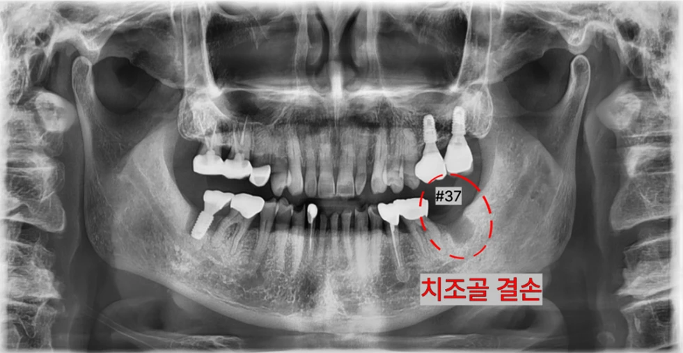 在其他牙科拔除种植体后 — 标记处为#37牙槽骨缺损