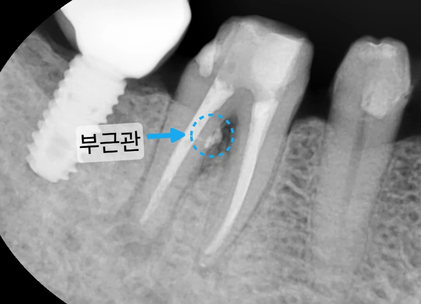 Phim quanh chóp răng sau khi trám ống tủy — ống tủy phụ (accessory canal) nối từ chân răng phía sau đến chẽ chân răng