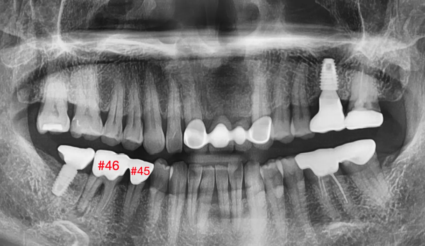 Khám ban đầu — #45 và #46 nối liền bằng mão răng hiện có (splint crown)