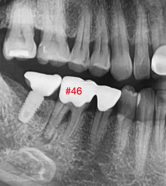 Cận cảnh #46 — vị trí chẽ chân răng dưới mão răng nối liền