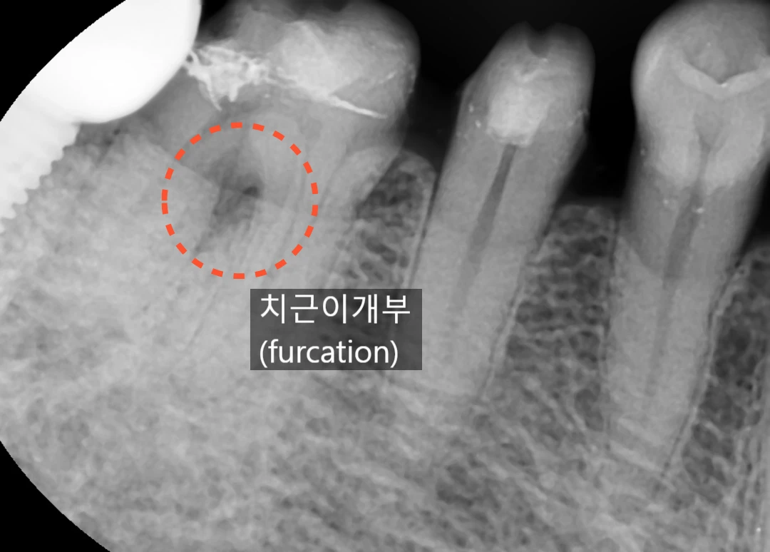 Phim quanh chóp răng ban đầu — Viêm tại vị trí chẽ chân răng (furcation), nơi các chân răng tách ra