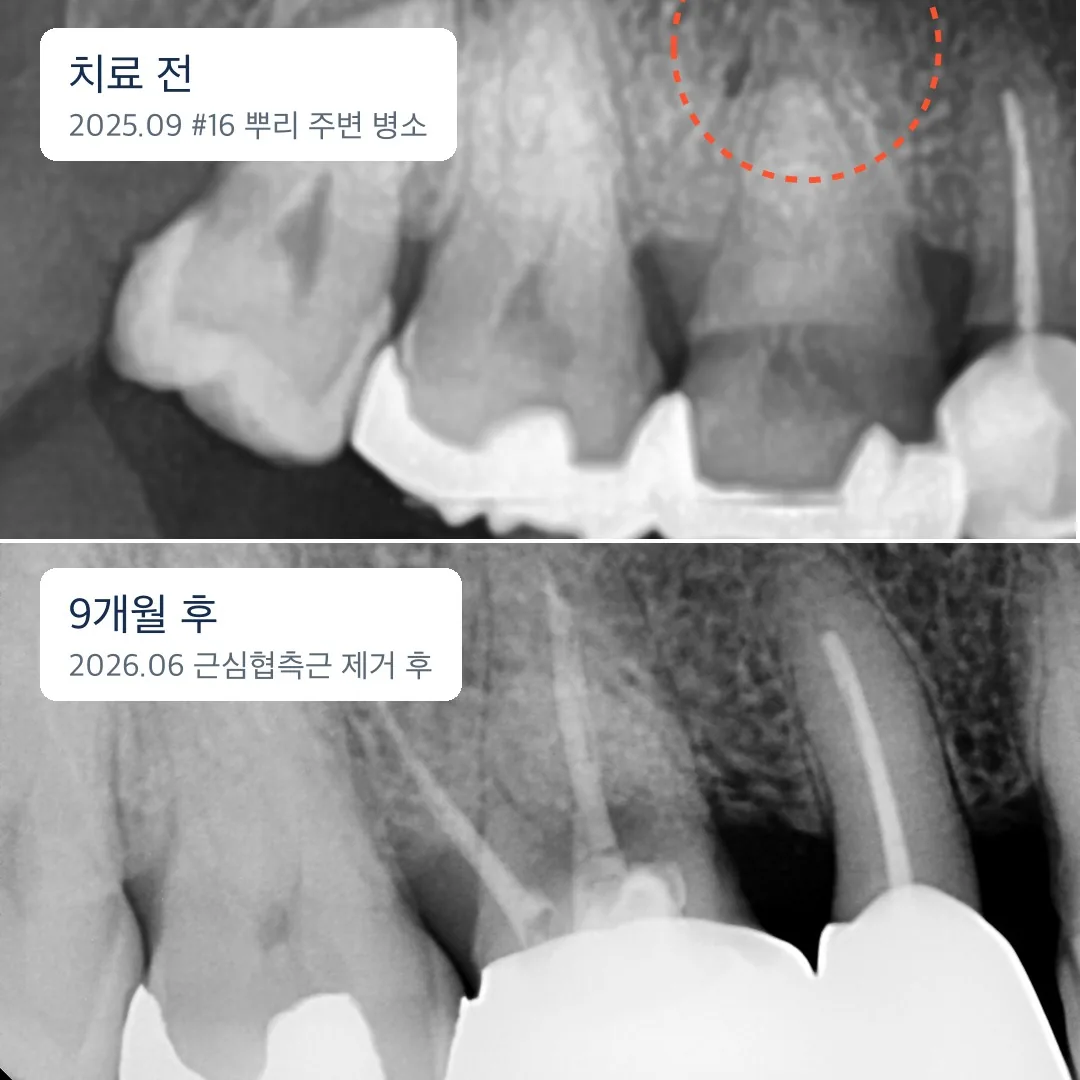 เปรียบเทียบภาพเอกซเรย์ปลายรากฟัน #16 รอยโรครอบรากด้านใกล้แก้ม (ก.ย. 2025) กับ 9 เดือนหลังตัดปลายราก (มิ.ย. 2026)