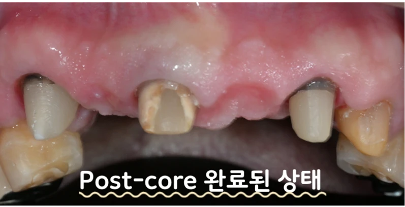 Sau khi tạo chốt-lõi — bên trong răng trụ được gia cố bằng trụ chốt